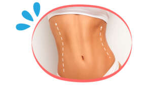 Abdominoplastie tunisie