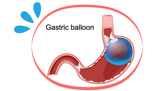 Ballon Gastrique tunisie