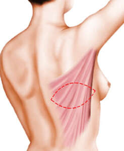 Reconstruction par lambeau de grand dorsal