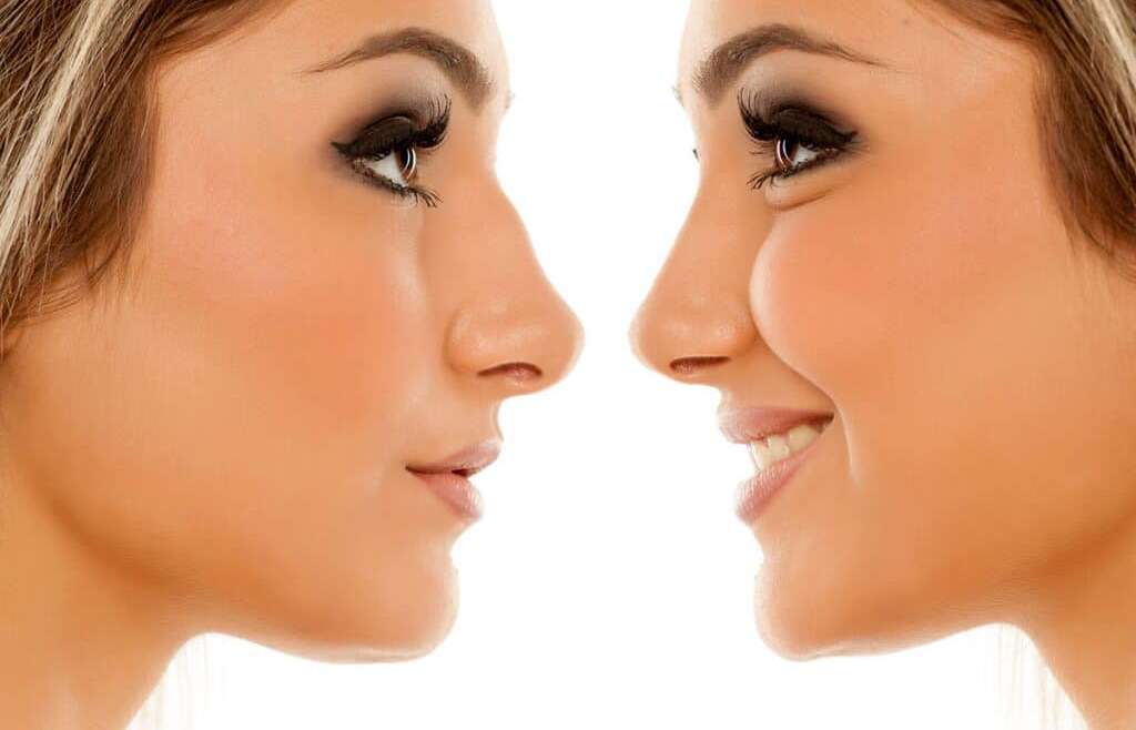 Rhinoplastie ultrasonique : le nez à l’épreuve des ultrasons