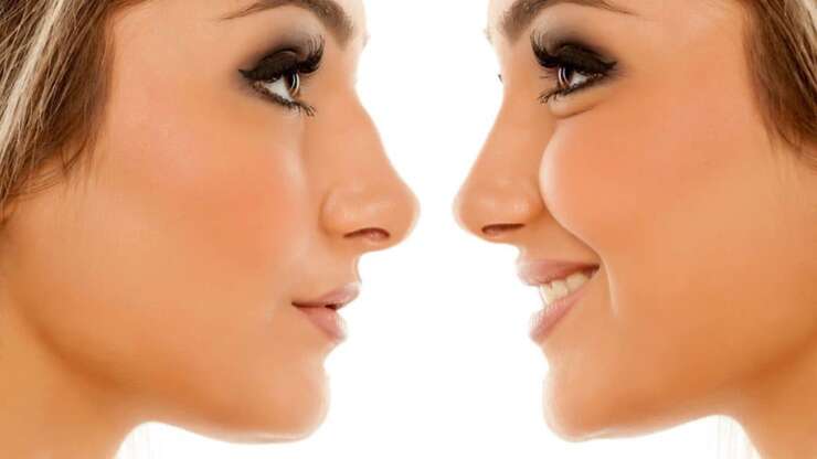 Rhinoplastie ultrasonique : le nez à l&rsquo;épreuve des ultrasons