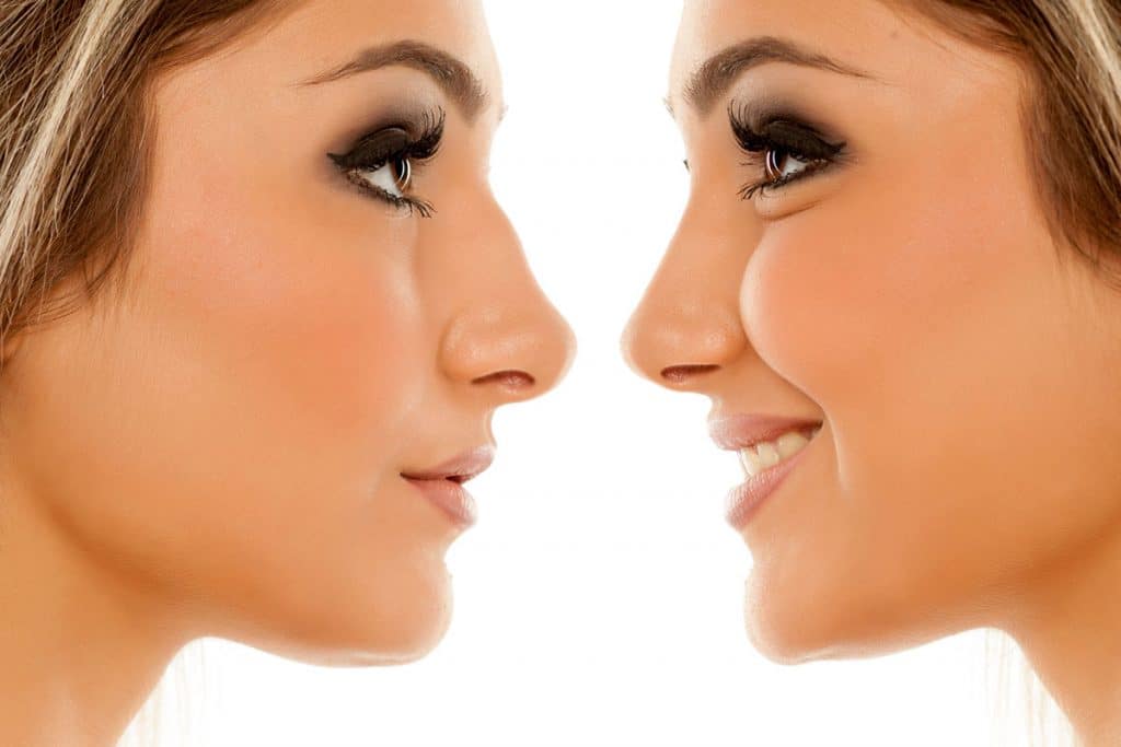 Rhinoplastie ultrasonique