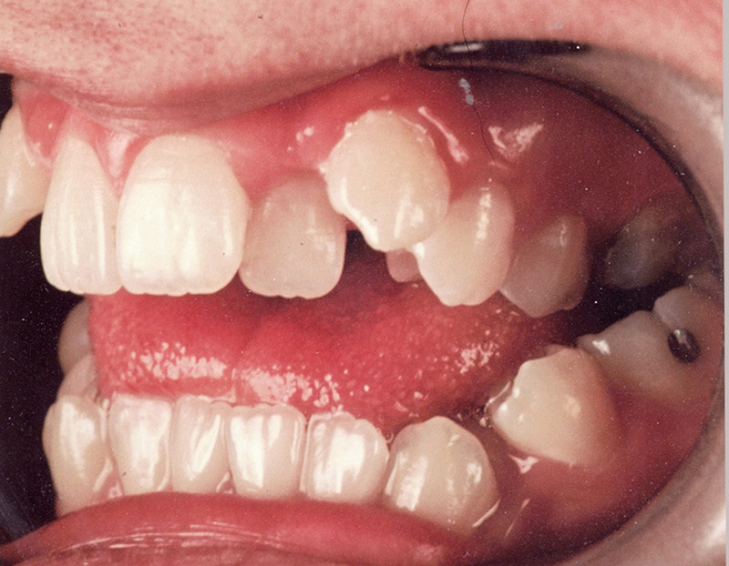 Alignement des dents 