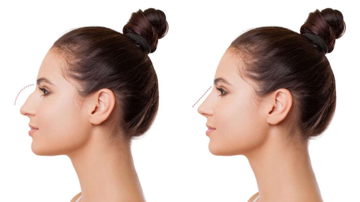 Rhinoplastie chirurgie nez