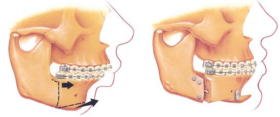 Chirurgie orthognatique